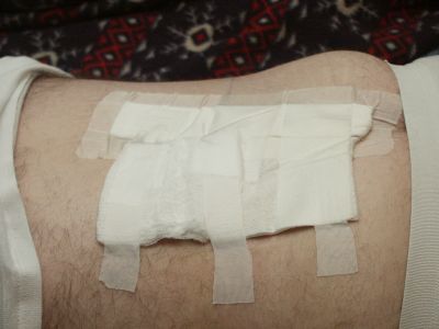 Bandage before removal